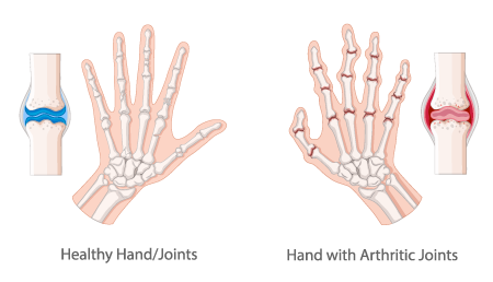 Arthritis Symptoms and treatment